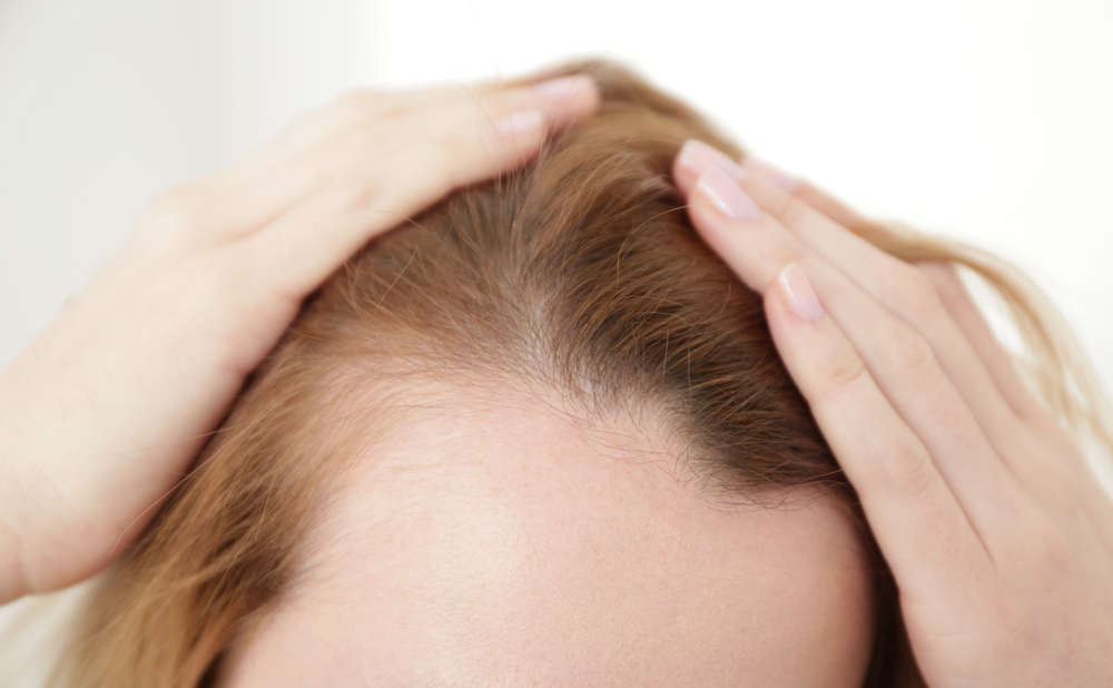 Hair Loss in Women - Renewed Vitality
