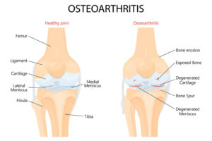 Knee Osteoarthritis and normal joint detailed anatomy.
